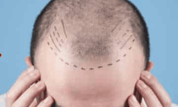 Hair Transplant