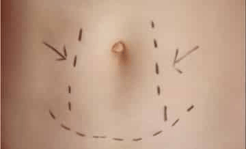 Liposuction